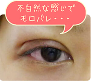二重埋没法後、腫れ食い込みが強い画像