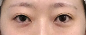 10DSC00966me-術前