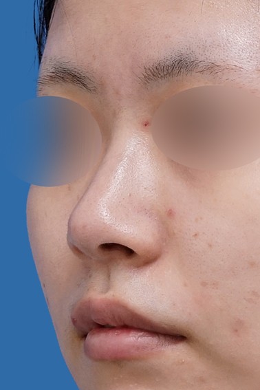 切らない鼻尖延長（ミスコ 8本） 斜め 1か月後のAfterの写真