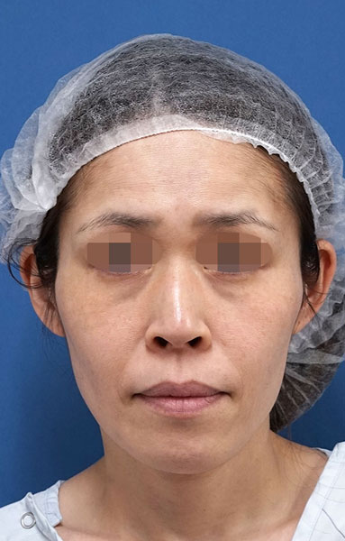目の下脂肪取り、脂肪注入（目の下・ほうれい線）　３ヶ月後　顔全体のBefore写真