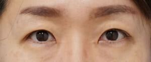 切る眼瞼下垂３ヶ月後