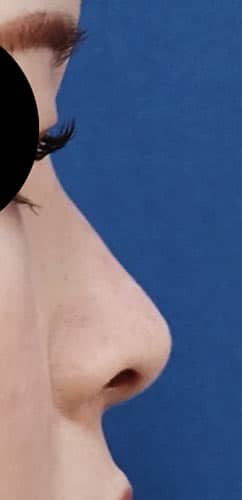 鼻尖縮小・軟骨移植・ストラット　６ヶ月後　右側面のAfterの写真