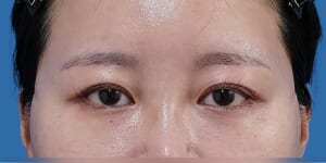 眉下切開 術後6か月 正面