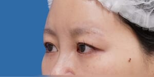 眉下切開 術前 斜め