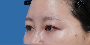 眉下切開 術後6か月 斜め