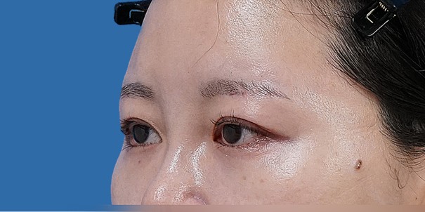 眉下切開 術後6か月のAfterの写真