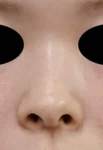 鼻尖縮小・軟骨移植・ストラット 手術前 正面
