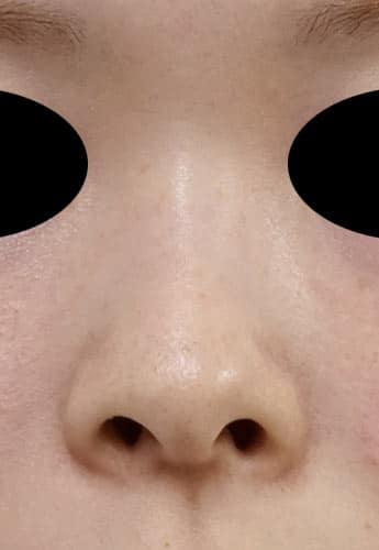 鼻尖縮小・軟骨移植・ストラット　６ヶ月後　正面のBefore写真