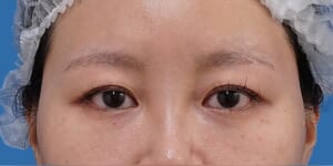 眉下切開 術前 正面