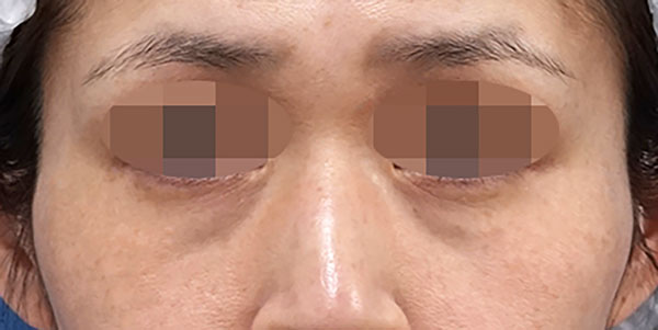 目の下脂肪取り、脂肪注入(目の下・ほうれい線) 3ヶ月後のBefore写真