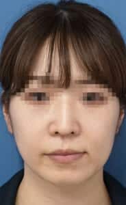 ほうれい線①1週間後サイズ修正
