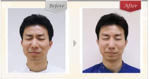 院長眉間ボトックス症例写真