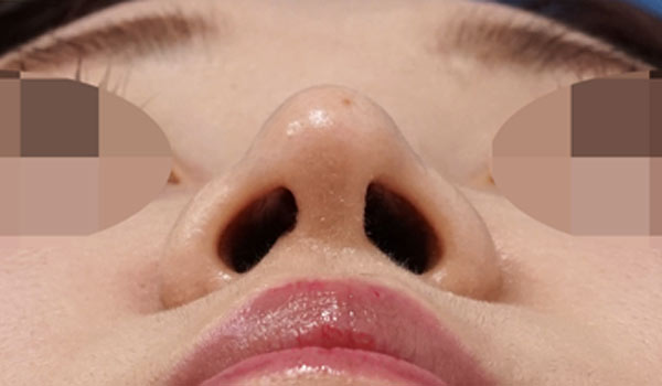 鼻尖縮小、耳介軟骨移植　６ヶ月後　下からのAfterの写真