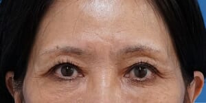 眉下切開 術後6か月