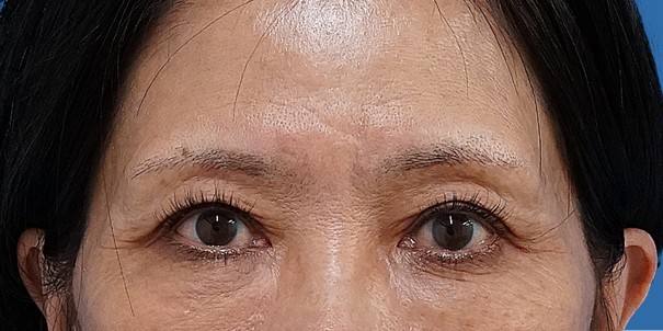 眉下切開 術後6か月のAfterの写真