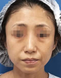 ゴルゴ線・目の下ほうれい線 処置前