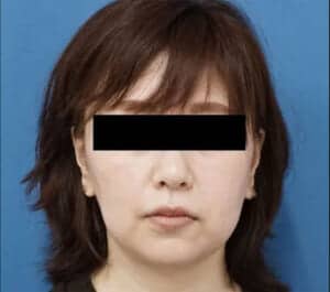 症例2 1か月後
