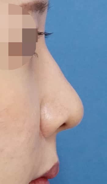 小鼻縮小（内側＋外側）、鼻尖縮小＋軟骨移植　３ヶ月後　右側面のAfterの写真