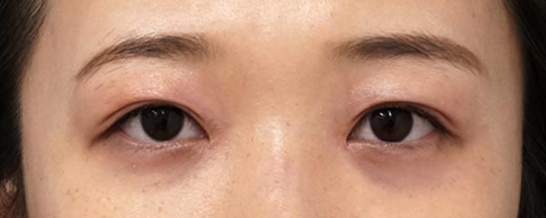 二重埋没法(3点連結埋没法)、目頭切開Z形成 6ヶ月後のAfterの写真