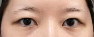 眉下切開＋目の上脂肪取り　術前