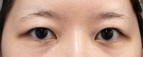 眉下切開+目の上脂肪取り 6ヶ月後のBefore写真