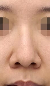 鼻翼縮小（内側＋外側）、鼻尖縮小、耳介軟骨移植　手術前　正面