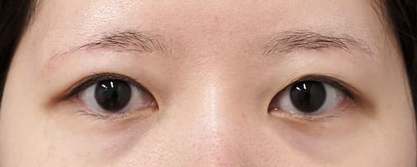眉下切開+目の上脂肪取り 6ヶ月後のAfterの写真