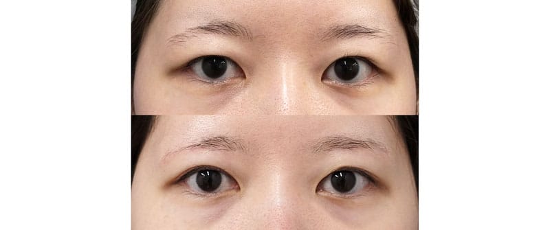 まぶたをすっきりさせて二重を広くしやすく｜眉下切開＋目の上脂肪取り　６ヶ月後