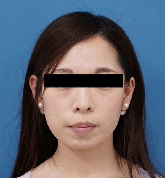 バッカルファット除去 3ヶ月後 正面のAfterの写真