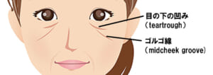 目の下凹みとゴルゴ線