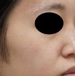 レーザー処置後