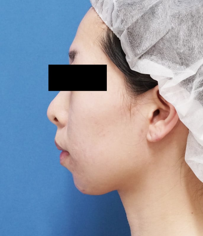バッカルファット除去 3ヶ月後 左側面のBefore写真