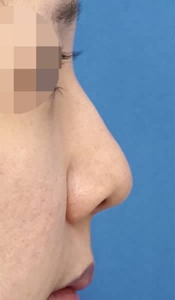 小鼻縮小（内側＋外側）、鼻尖縮小＋軟骨移植　３ヶ月後　右側面のBefore写真