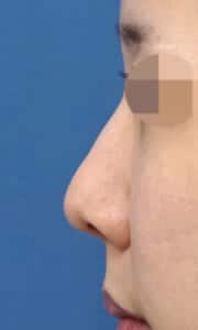 鼻翼縮小（内側＋外側）、鼻尖縮小、耳介軟骨移植　手術前　左側面