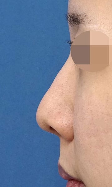 小鼻縮小（内側＋外側）、鼻尖縮小＋軟骨移植　３ヶ月後　左側面のBefore写真