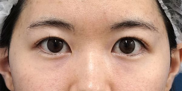 眉下切開　手術前