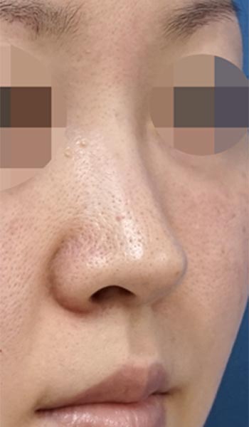 鼻尖縮小、耳介軟骨移植　６ヶ月後　右斜めのBefore写真