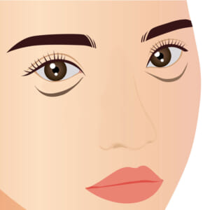 目の下のしわっぽ涙袋ヒアルロン酸