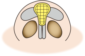 鼻尖軟骨移植(shield garft)