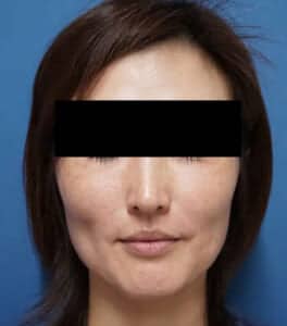 フォトシルク処置前