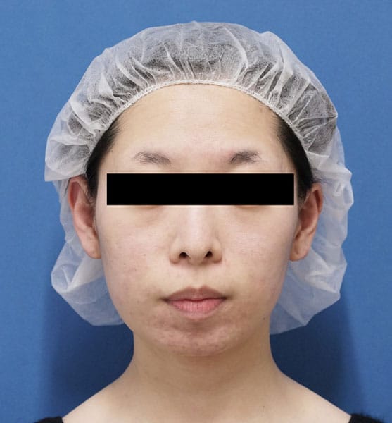 バッカルファット除去 3ヶ月後 正面のBefore写真
