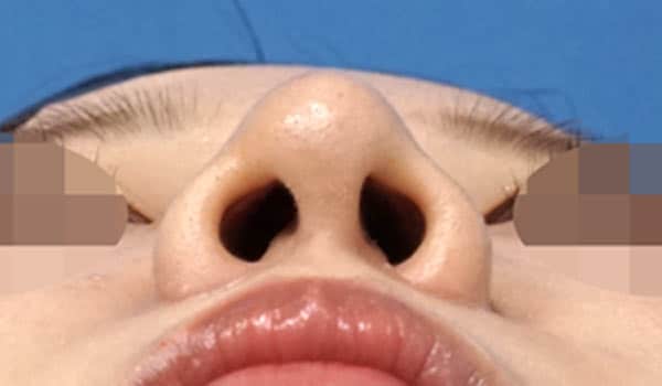 小鼻縮小（内側＋外側）、鼻尖縮小＋軟骨移植　３ヶ月後　下からのAfterの写真