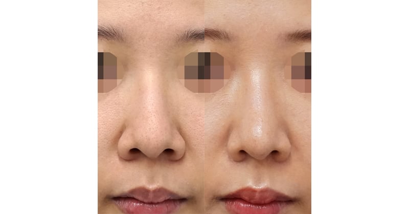 自然に鼻をすっきりさせる｜小鼻縮小（内側＋外側）、鼻尖縮小＋軟骨移植　３ヶ月後　