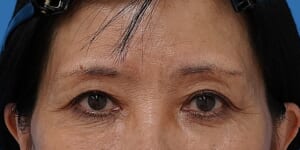 眉下切開 術後3か月