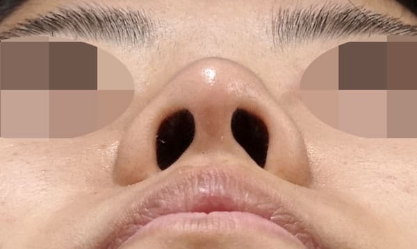 鼻尖縮小・軟骨移植 6ヶ月後 下から