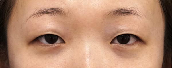 二重埋没法（もとびアイプラチナム）、目頭切開Z形成　手術前