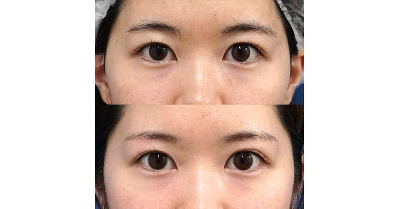 たるみで台形になった二重を丸く整える｜眉下切開（真ん中のみ）　６ヶ月後