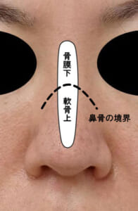 プロテーゼの位置、骨膜下剥離の位置