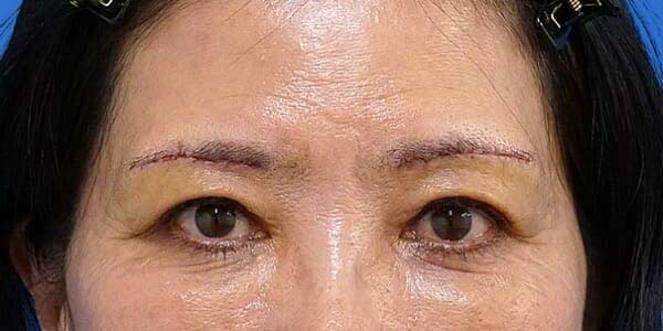 眉下切開 術後5日（抜糸直後）のAfterの写真