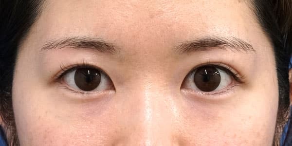 眉下切開　６ヶ月後